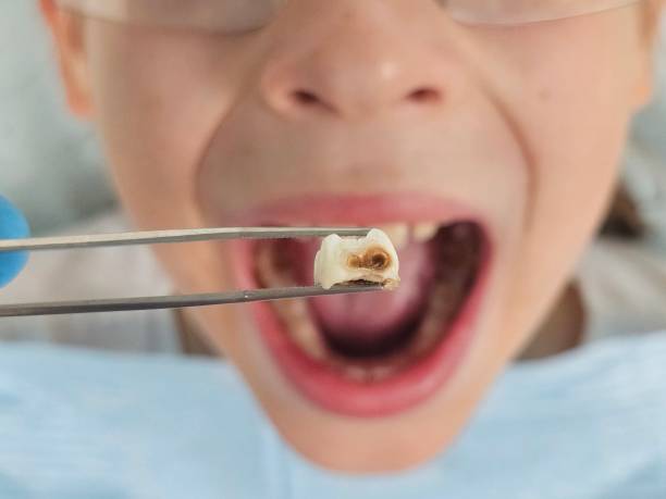 Best Emergency Tooth Extraction in Sage, CA